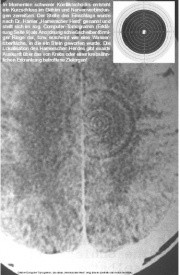 Ringartefakt, der von Hamer als ca-Phase-HH bezeichnet wird