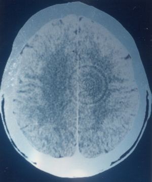Von Hamer präsentierter Ringartefakt, der ein "Hamerscher Herd" sein soll