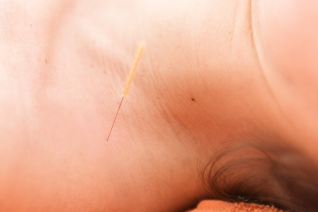 Dry Needling PhysioPlus GmbH Widnau Heerbrugg St. Margrethen Diepoldsau Rheintal effiziente Triggerpunktbehandlung mit Nadeln ©nussbaumerphotography.com