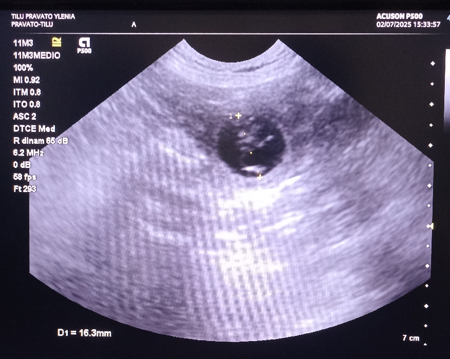 Ecografia di conferma gravidanza di Tilu'🤰🏻