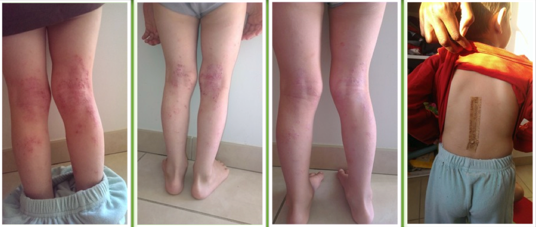 Eczema sur un enfant de 3 ans, 15 jours et 30 jours après