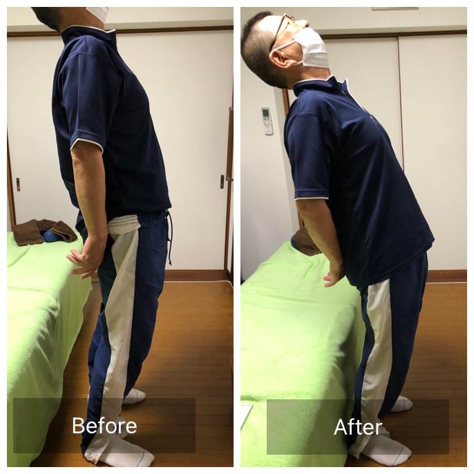 腰痛で腰を反らすことができないお客様の施術前後