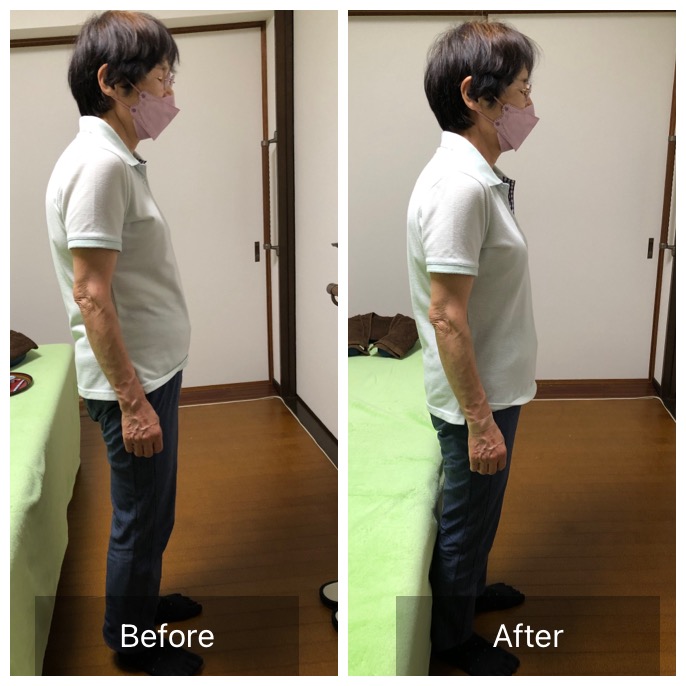 10年以上猫背に悩んでいるお客様の猫背改善（施術前後）