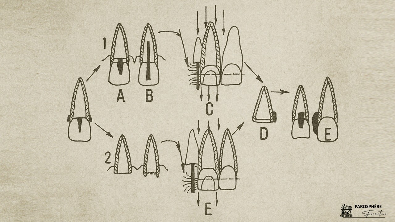 L'égression orthodontique - Un protocole innovant en 1973
