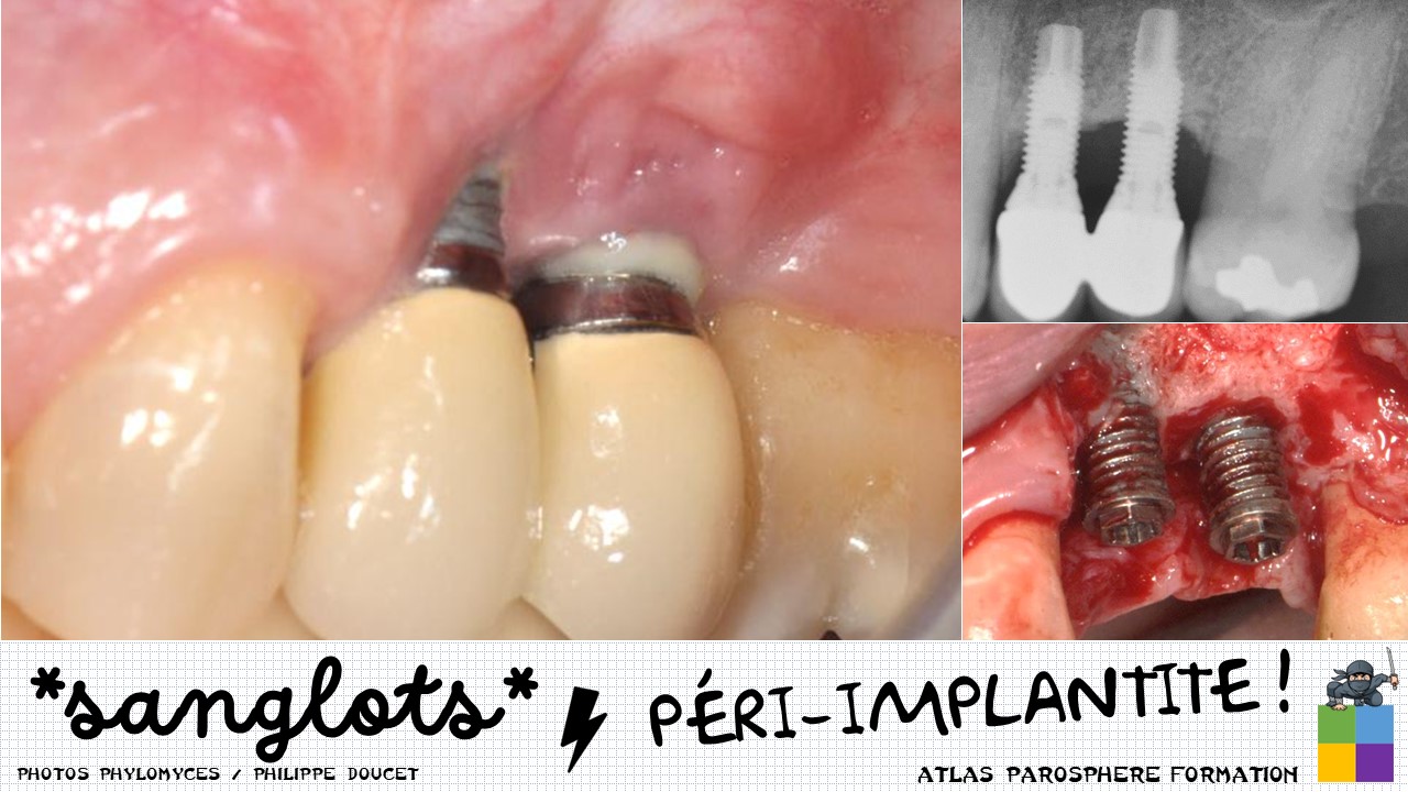 Infections péri-implantaires