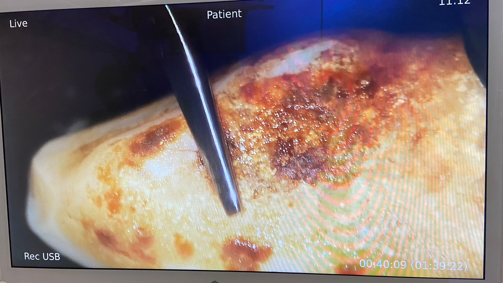 PSF | Les micro-inserts à l'épreuve du microscope opératoire