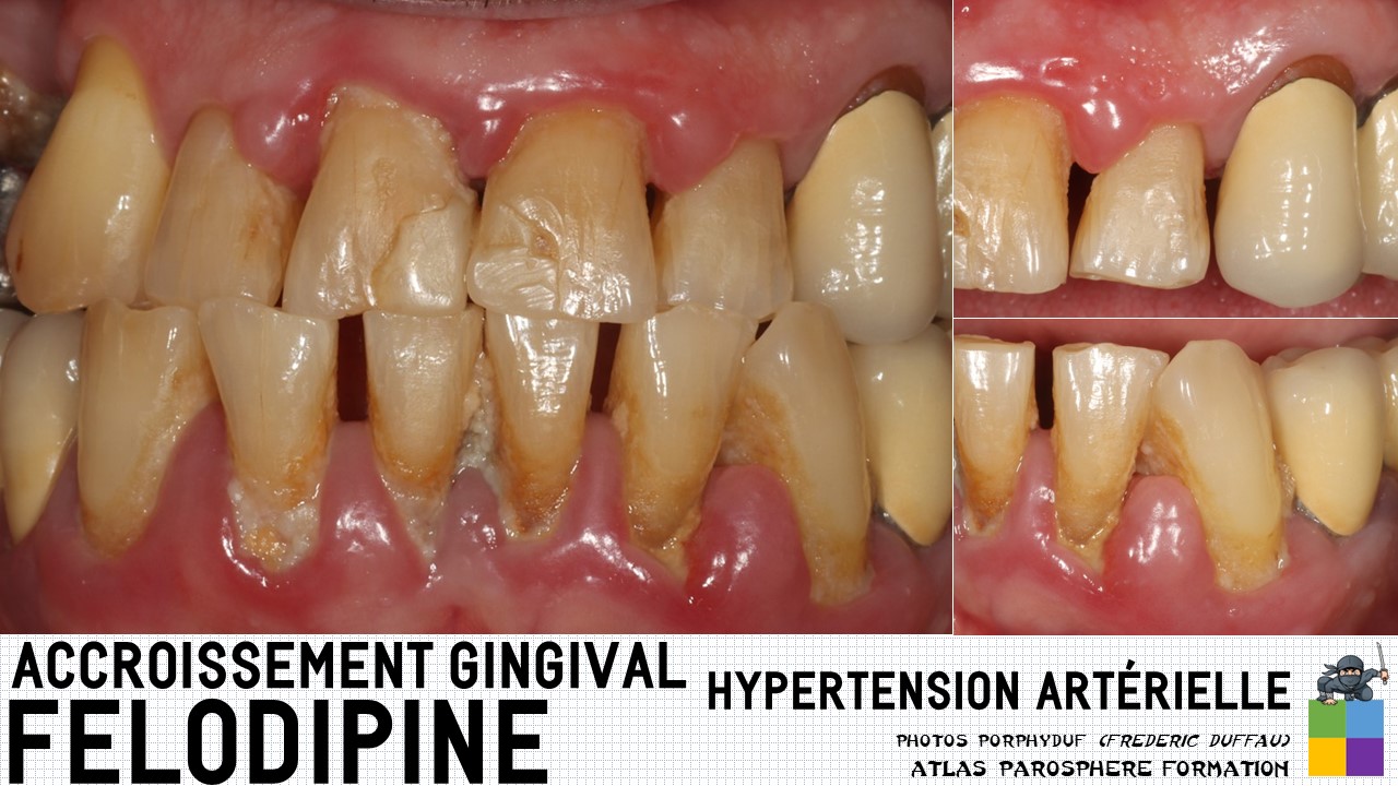 Accroissement gingival [médicaments]