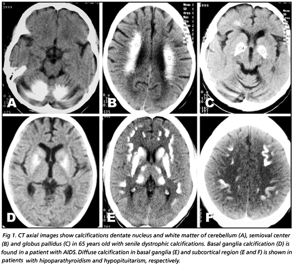 Fahr's syndrome CT findings