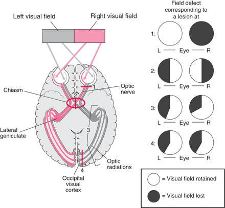 Optic nerve tract and visual defects in different lesion sites