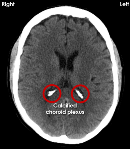 Calcified Choroid plexus