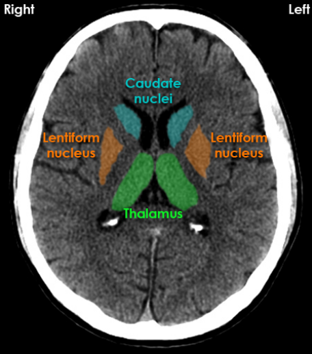 Brain CT - NeurologyNeeds.com