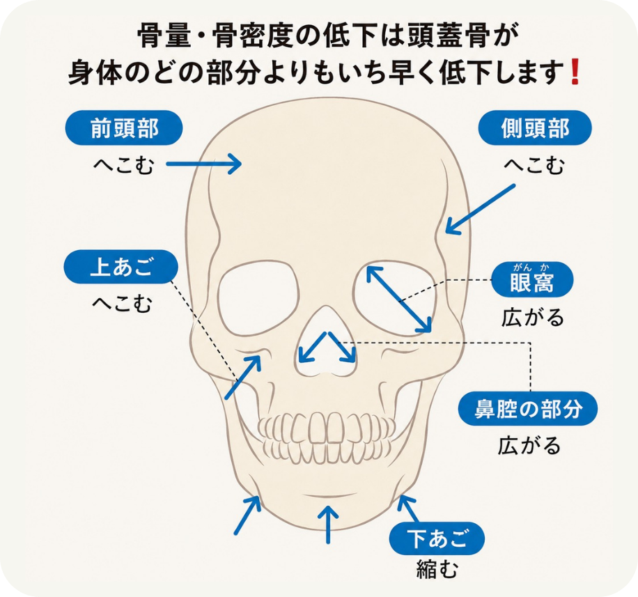 骨粗鬆症　骨粗しょう症　美容　たるみ　へこみ　しわ　シワ　皺