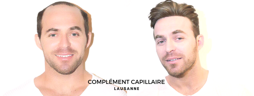 Le Remplacement De Cheveux Sans Chirurgie Site De En Particulier Le rasage tout en douceur. remplacement de cheveux sans chirurgie