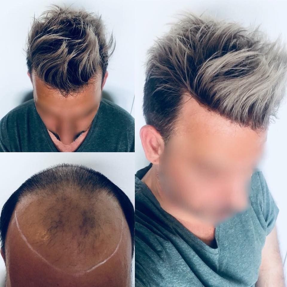 Le Remplacement De Cheveux Sans Chirurgie Site De En Particulier