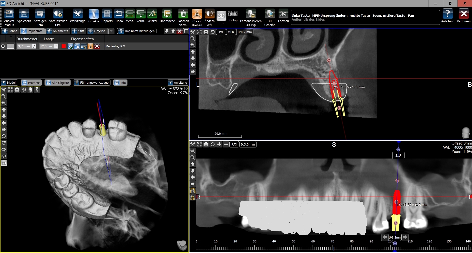 DVT-Aufnahmen Implantate