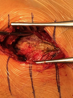 The layer below : up, the iliopsoas muscle, at the middle the capsula, down, the gluteal. Dr Rémi, Toulouse.