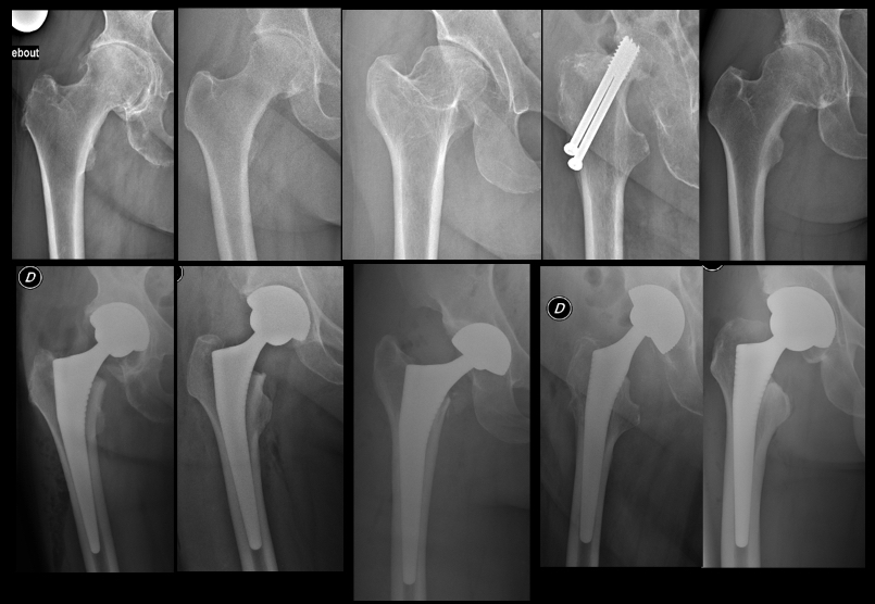 Total hip arthroplasty, leg lenght discrepancy, Dr Rémi orthopaedic surgeon, Toulouse France Clinic Capio Croix du Sud