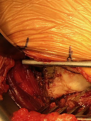 Enter the capsula and you see the femoral neck. Dr Rémi, Toulouse.
