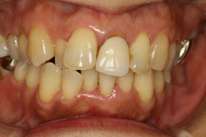歯並びを全体的な審美歯科治療で治した治療例。