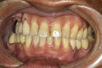 下がった歯茎と審美歯科の関係