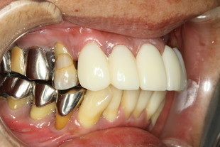 歯周病と仮歯