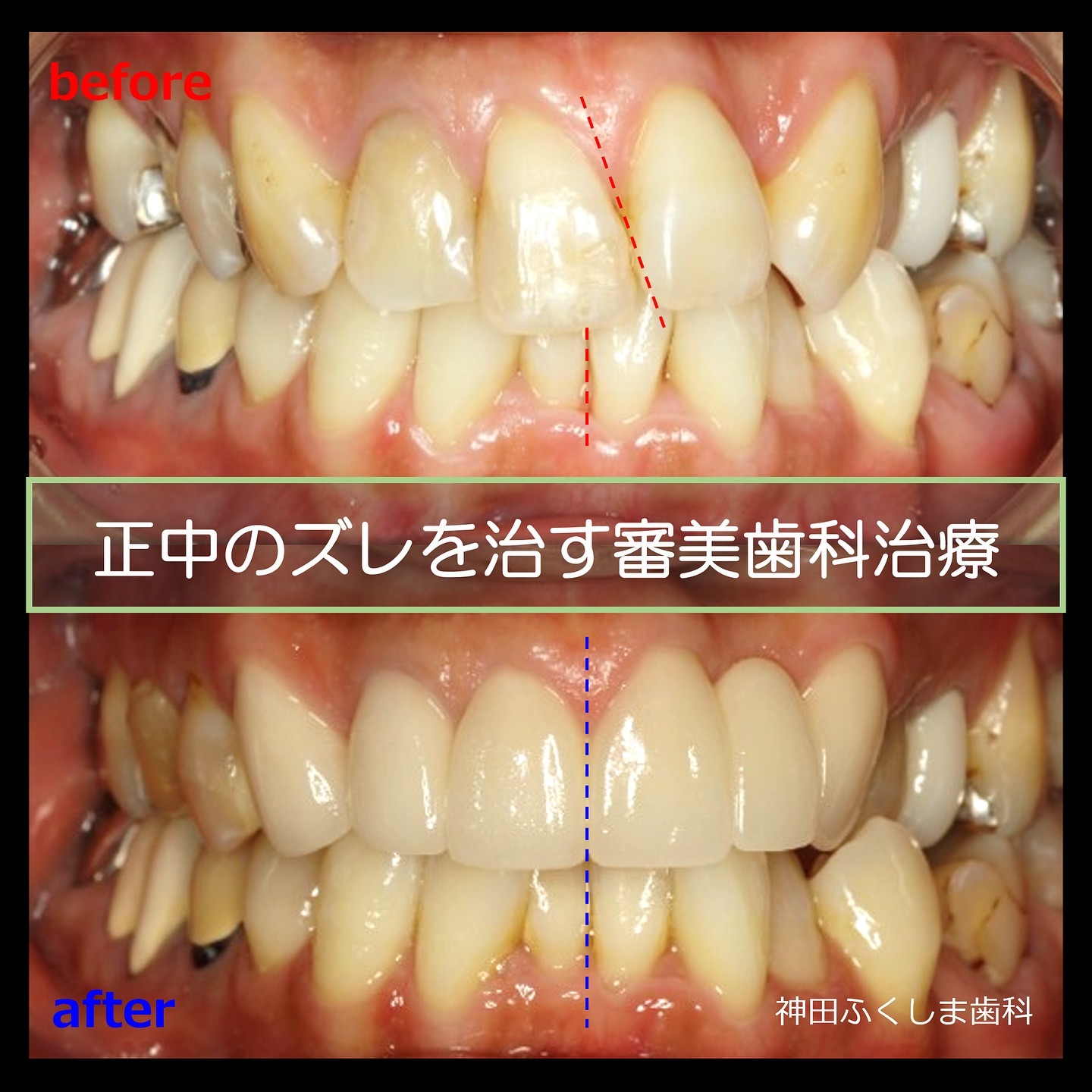 歯並びを変えるために審美歯科治療を行う場合の秘訣