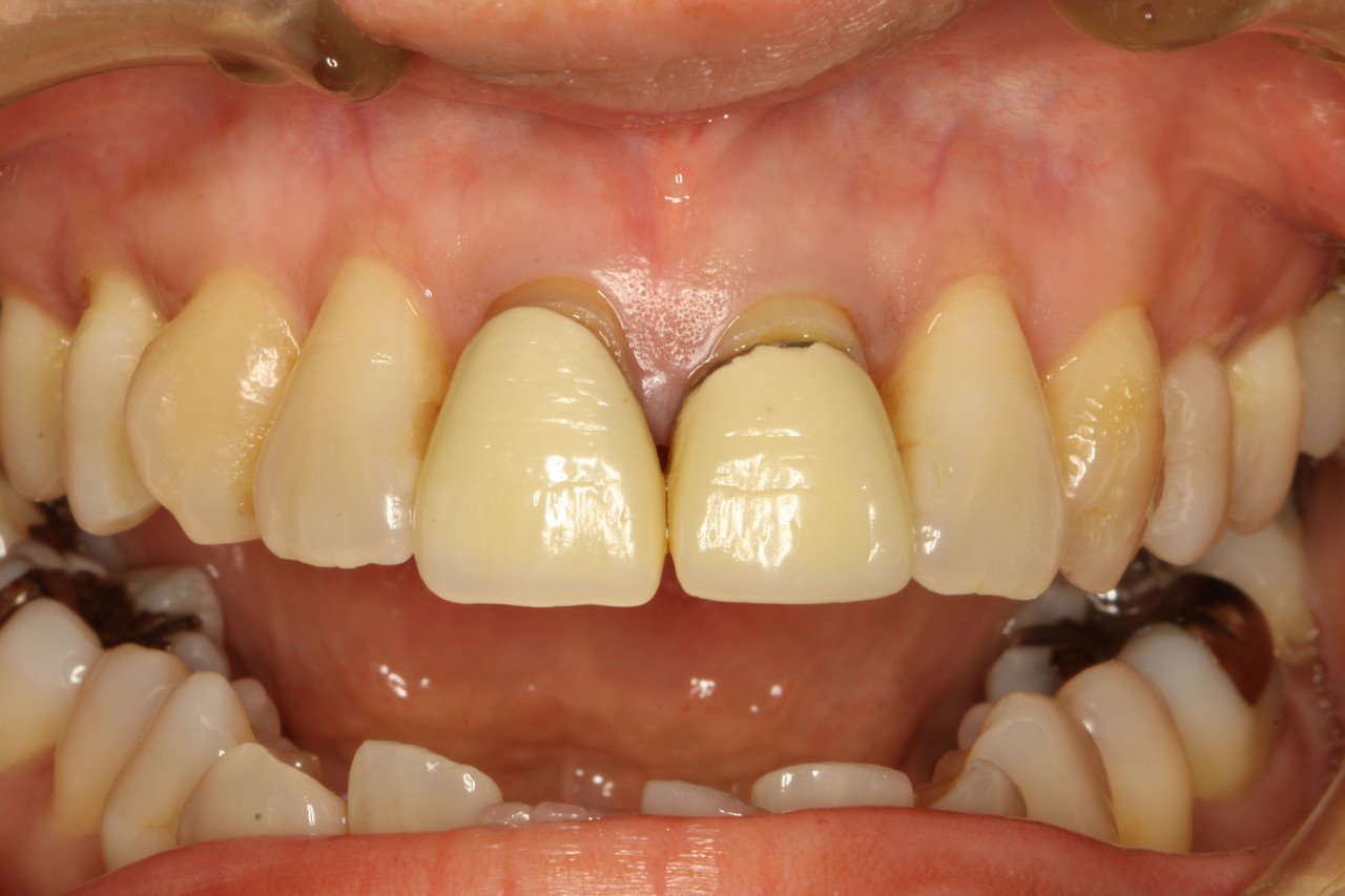 歯茎が下がったときの審美歯科治療 審美歯科の専門ページ