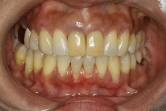 審美歯科ブログ　歯茎の再生と審美歯科の症例の紹介