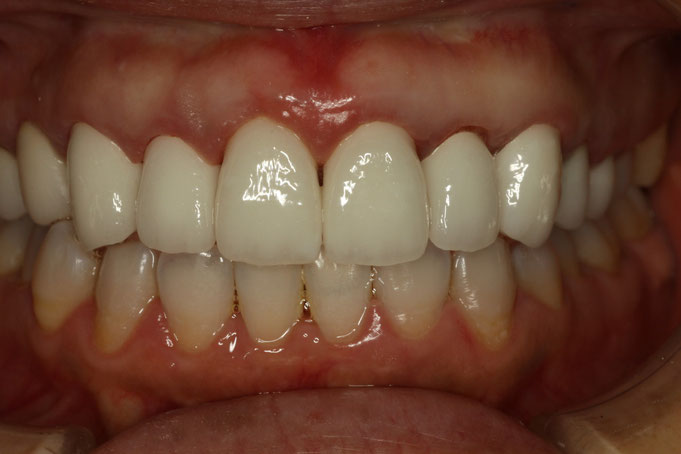 歯茎の長さの微調整のために歯茎の再生治療を行ったケース