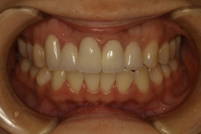 左右の差し歯の長さがちがうと見た目が悪い？