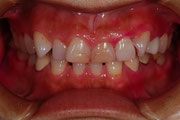 審美歯科ブログ　歯茎の整形 左右の形をそろえる審美歯科治療