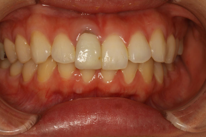 差し歯の歯茎が黒くなるのが心配な方のための審美歯科治療。差し歯の歯茎の黒ずみ解消。歯茎の審美歯科で明るい笑顔を取り戻します