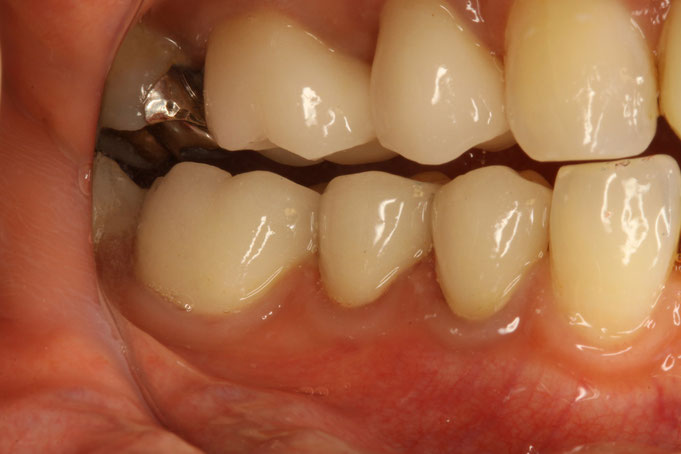 奥歯の審美歯科はオールセラミックでは