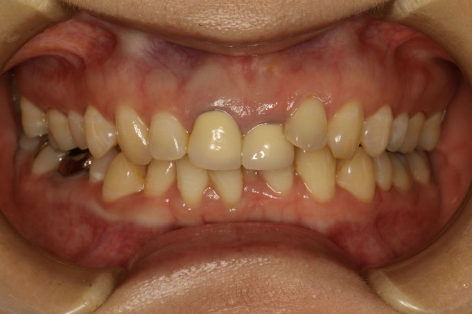 審美歯科と歯並びについて