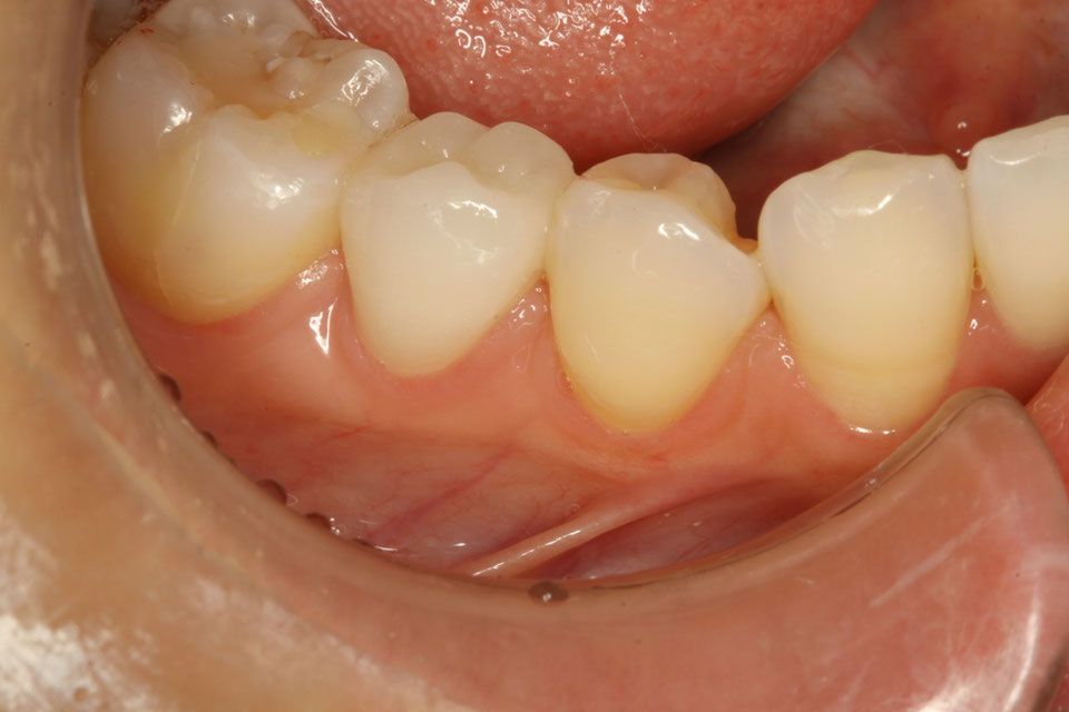奥歯のオールセラミックを自然な感じにしたい場合も対応できます。