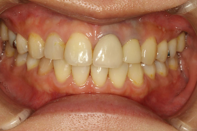 オールセラミック治療例　差し歯とホワイトニングについて.