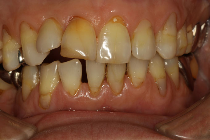 審美歯科治療前に歯茎をしっかりと確認してください。