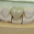 審美歯科ブログ　メタルボンドセラミックは昔からあるセラミックです。