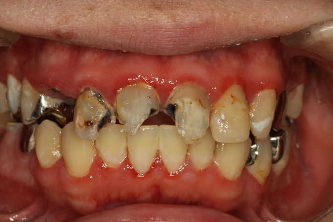 歯がボロボロになってしまっても審美歯科できれいにできます．