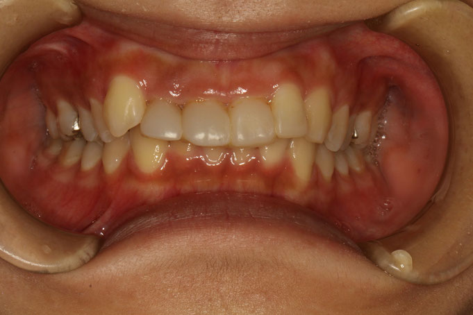 差し歯の歯ぐきが下がって気になる方。歯茎の審美歯科治療をご存知ですか？