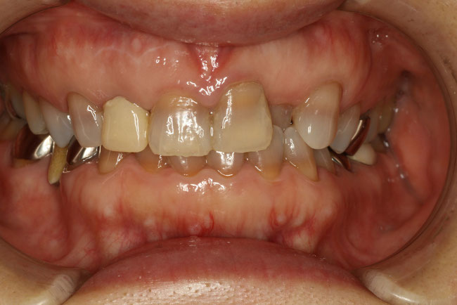 変色した歯をセラミックで治療する場合、透明感を決めることが重要になります。