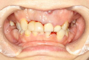 審美歯科治療だけど歯の大きさを変える？