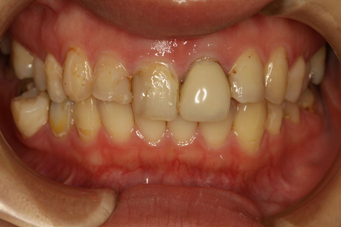 あなたも前歯の差し歯をオールセラミックできれいになります。