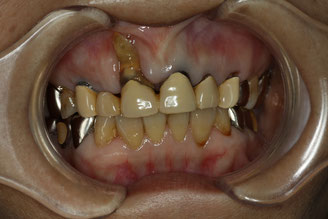 新しい審美歯科では、オールセラミックでブリッジの歯茎の形を作ります。