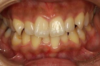 審美歯科Blog　歯並びと歯の大きさを審美的に治したケース