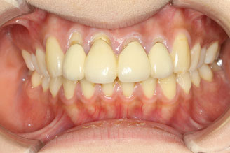 差し歯の歯茎が下がって黒ずみが気になる！何とかしたい！！という方にお勧めの審美歯科治療法とは