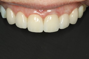 審美歯科Blog　オールセラミックの色は自然な感じか、真っ白い色か好みによって変えられます。