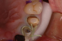 審美歯科治療中の疑問にお答えします。歯茎に糸を入れるって何のため？