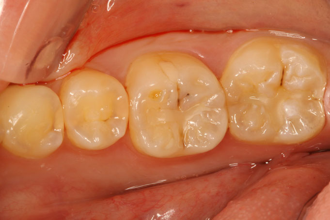 歯と歯の間の虫歯を審美歯科治療する場合