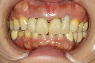 審美歯科Blog　歯茎の形を整える部分矯正法とは